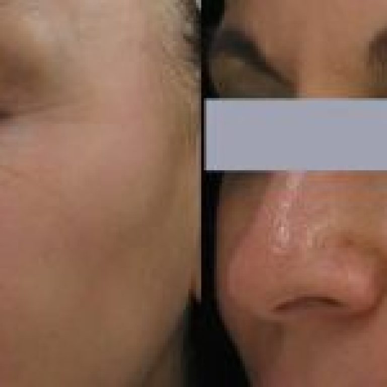 1-collagen-induction-therapy-before-after-1-r6oq1h1yigm39ircj9upywpvitwglg8zs684uw5vq4