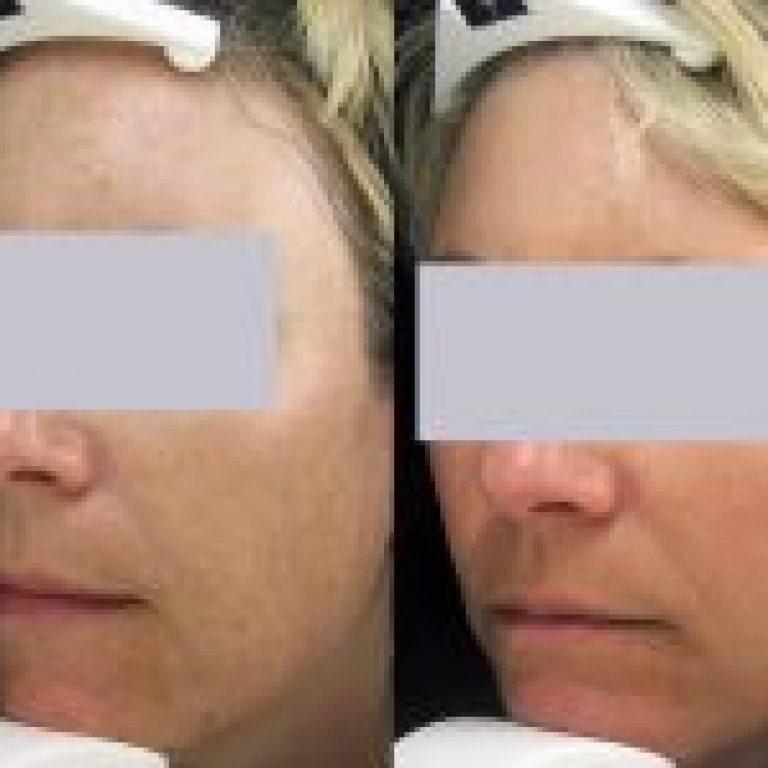 1_agespot-removal-before-after-laser-treatment-r6oq1h1yigm39ircj9upywpvitwglg8zs684uw5vq4