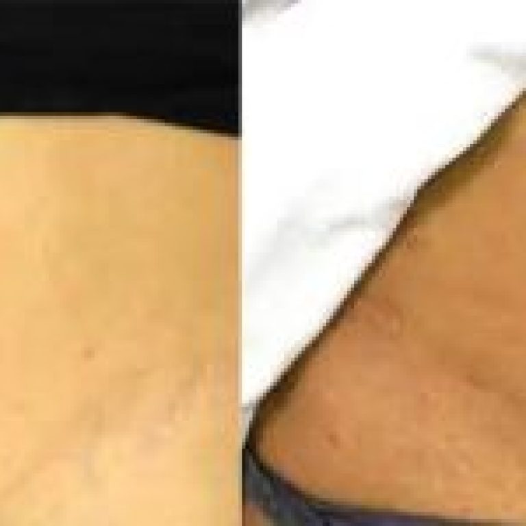 1_before-and-after-treatment-with-lasers-to-reduce-stretch-marks-r6oq1h1yigm39ircj9upywpvitwglg8zs684uw5vq4