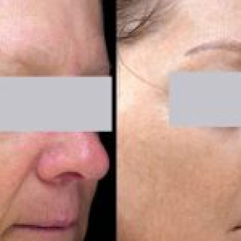 1_laser-rosasea-treatment-befre-after-r6oq1h1yigm39ircj9upywpvitwglg8zs684uw5vq4
