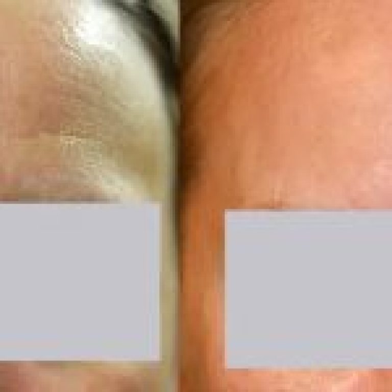 1_scar-removal-laser-treatment-before-and-after-r6oq1h1yigm39ircj9upywpvitwglg8zs684uw5vq4