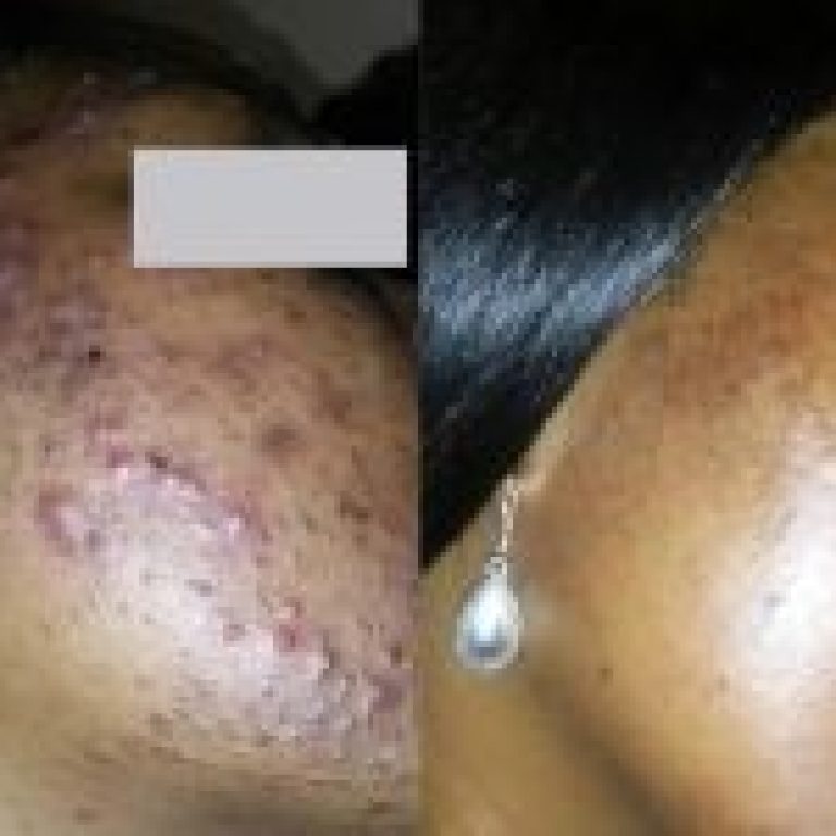 AcneBeforeAndAfter06-r6oq1g44bmksxwsporg3eeyexg13dr59g1kndm79wc