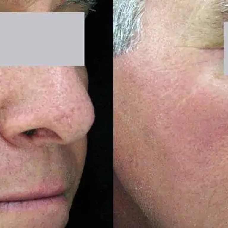 BirthmarkBeforeAndAfter2
