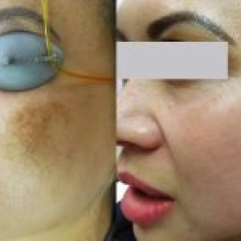 MelasmaBeforeandAfter02-r6oq1h1yigm39ircj9upywpvitwglg8zs684uw5vq4