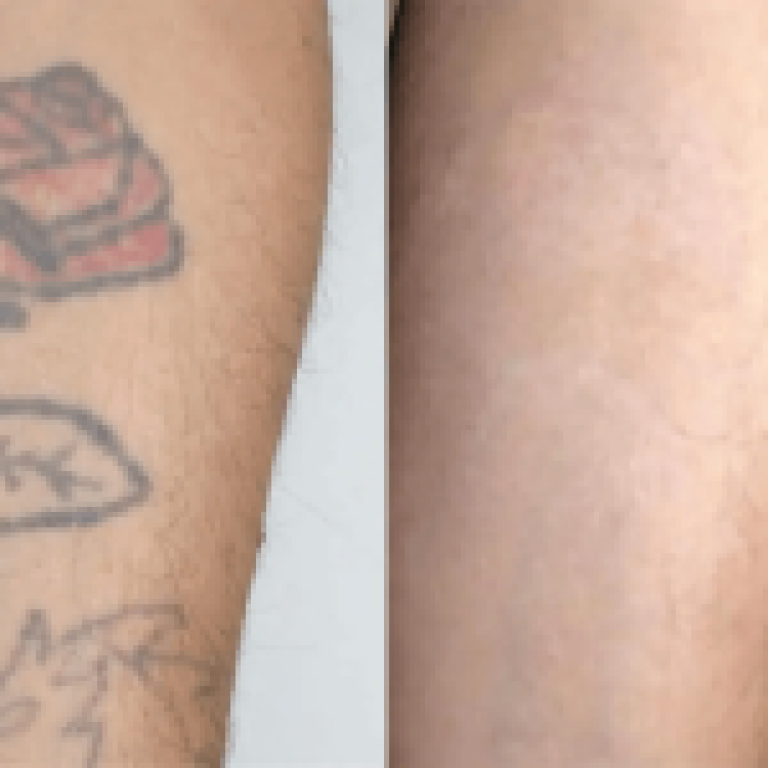TattooRemovalBeforeandAfter01-rn2sc9te98h34g86hwsdirvf1ok9vmr42lr1sm1of0