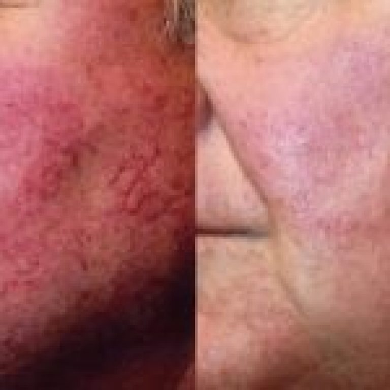 before-and-after-laser-treatment-for-rosacea-r6oq1g44bmksxwsporg3eeyexg13dr59g1kndm79wc