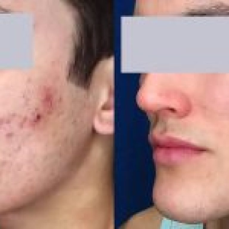 laser-cystic-acne-treatment-before-and-after-3-r6oq1h1yigm39ircj9upywpvitwglg8zs684uw5vq4