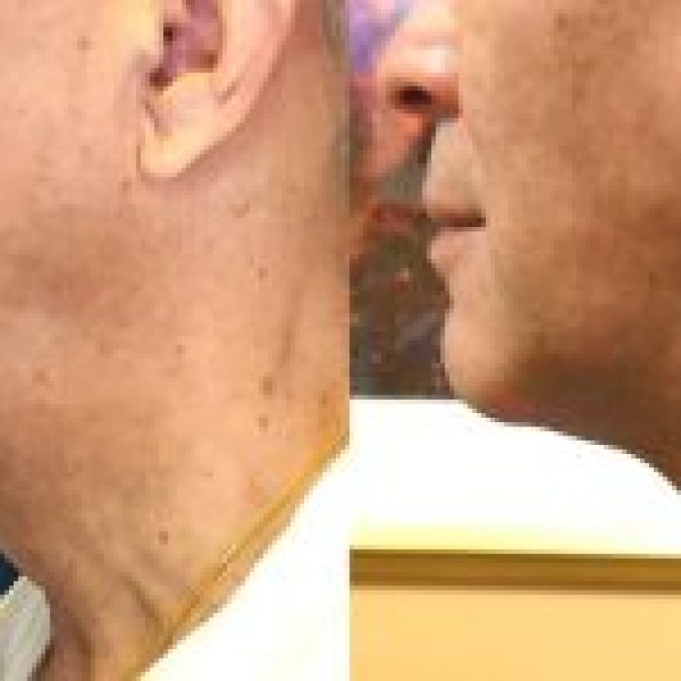 laser-turkey-neck-removal-before-after-r6oq1h1yigm39ircj9upywpvitwglg8zs684uw5vq4