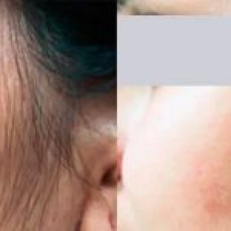 laserhairremovalbeforeandafter01-r6oq1h1yigm39ircj9upywpvitwglg8zs684uw5vq4